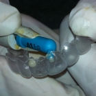 Hard composite material is used to fill the attachment dimples